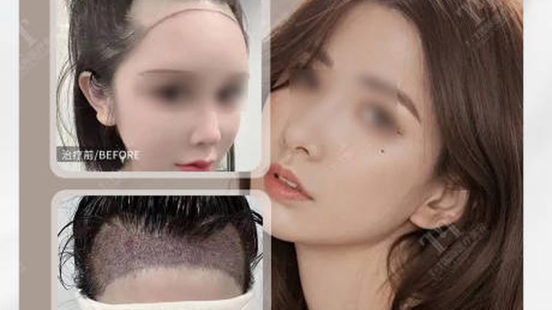 超声炮术后护理，这几点不能忽视**