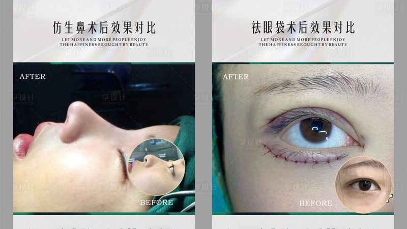 光子嫩肤：揭秘费用构成与影响因素**