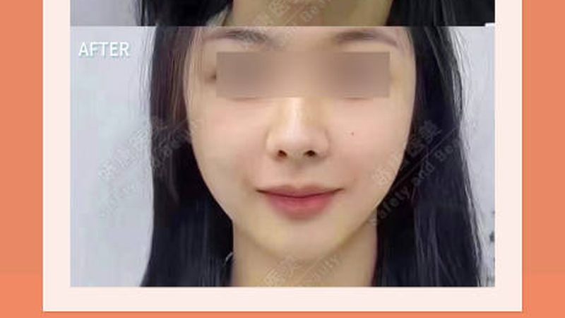 鼻整形术后，墨镜佩戴的最佳时机