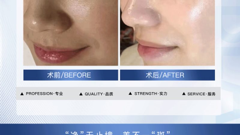IPL激光祛斑仪操作步骤详解，掌握祛斑新技能