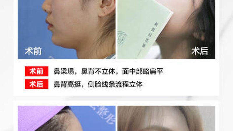 黄褐斑激光治疗：揭秘真实案例，了解技术原理
