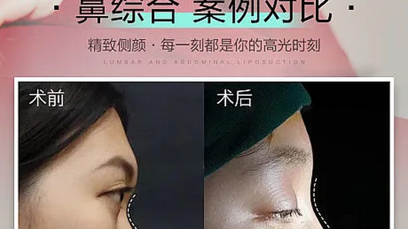 医美全麻：了解其优缺点，安全塑形无忧