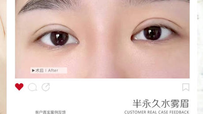 激光脱毛粗了怎么恢复