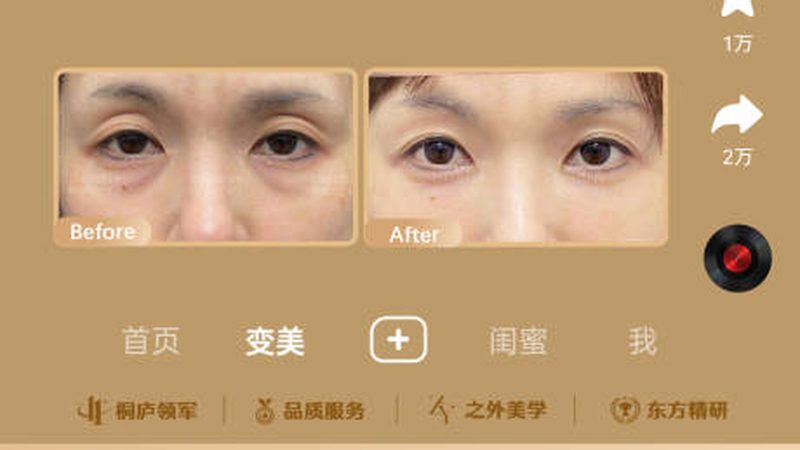 广州光子嫩肤团购术前准备方法